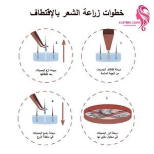 مراحل زراعة الشعر الطبيعي وزراعة اللحية