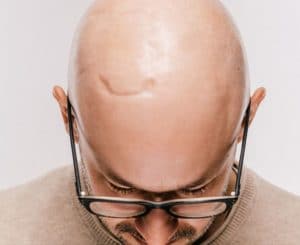 علاج الحروق الجلدية (التشوهات وطرق علاجها) بزراعة الشعر فوق الندبات والجروح