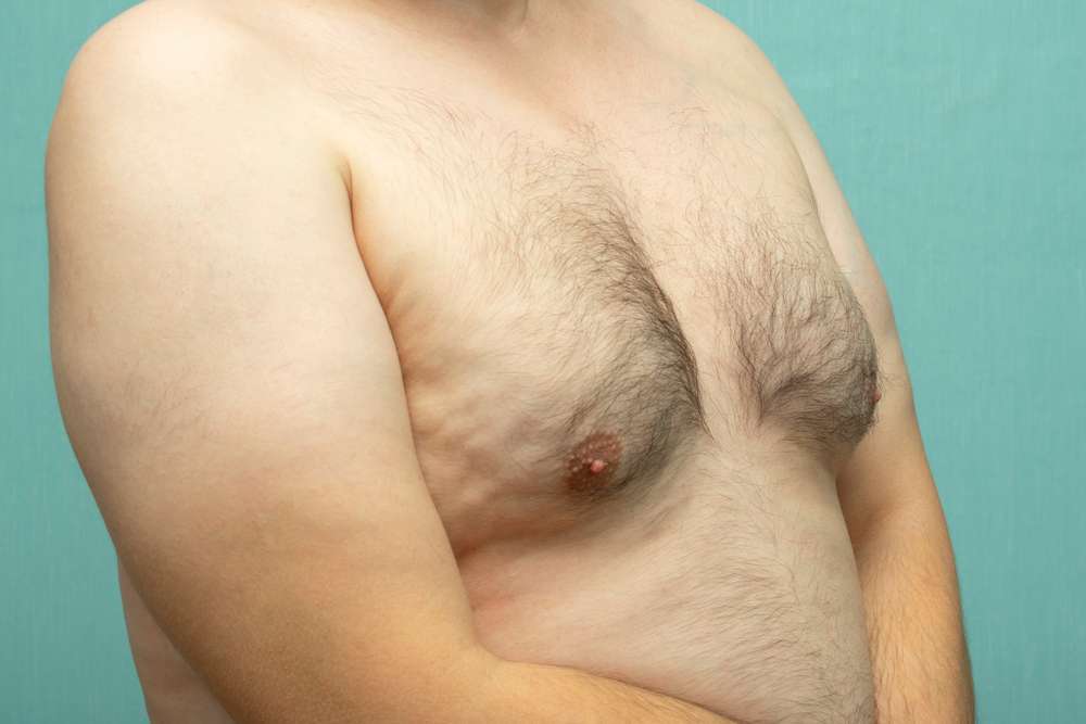 التثدي عند الرجال اسبابه وعلاجه