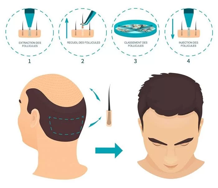 فوائد زراعة الشعر بالإقتطاف