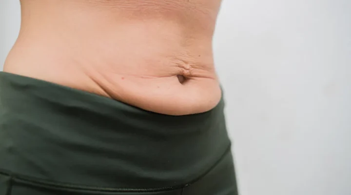 شد الترهلات بعد التكميم