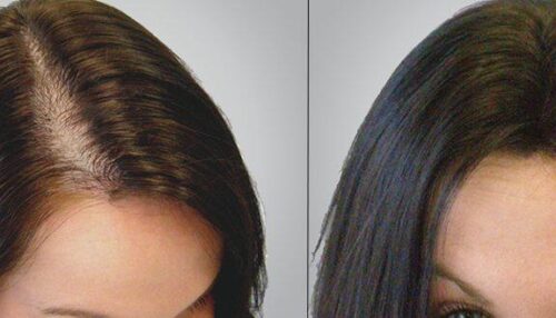 عمليات زراعة الشعر للنساء