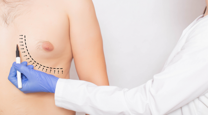 علاج التثدي عند الرجال طبيعيا