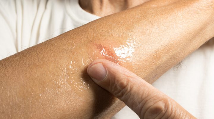 علاج الحروق