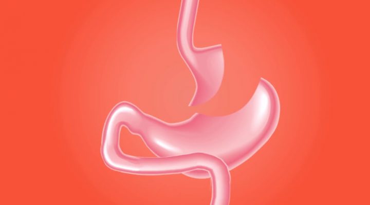 عمليات تدبيس المعدة