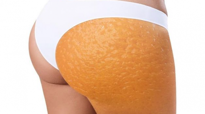 التخلص من السيلوليت