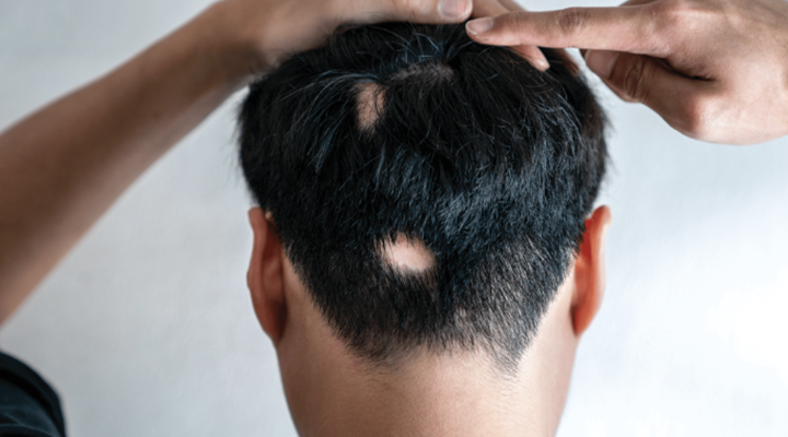 علاج الثعلبة