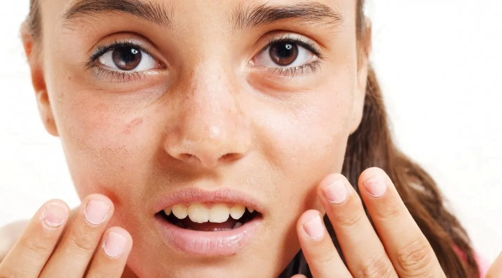 علاج الكلف بالليزر