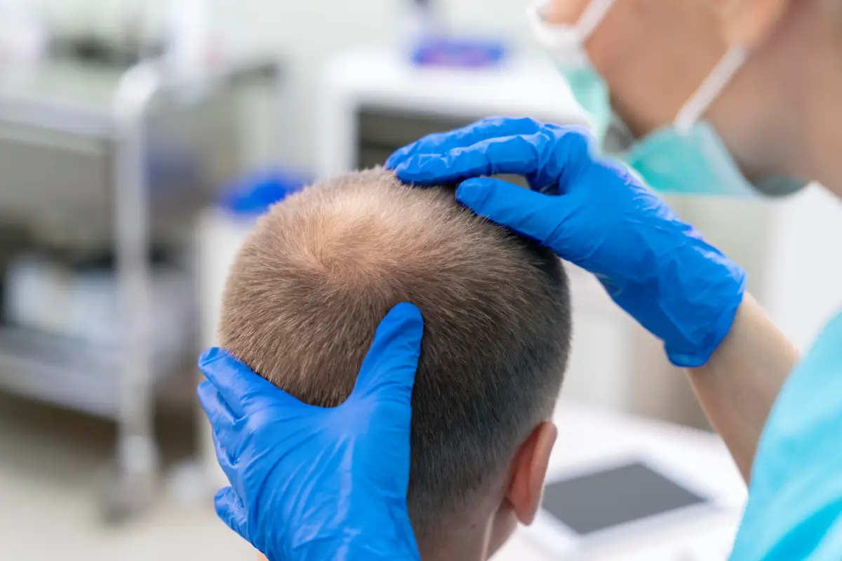 افضل دكتور زراعة شعر في مصر