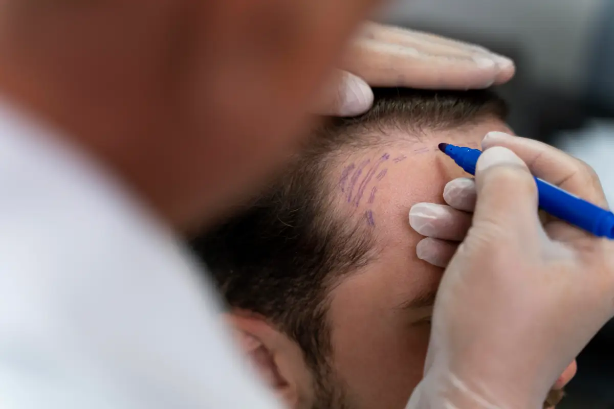 تكلفة زراعة الشعر في مصر