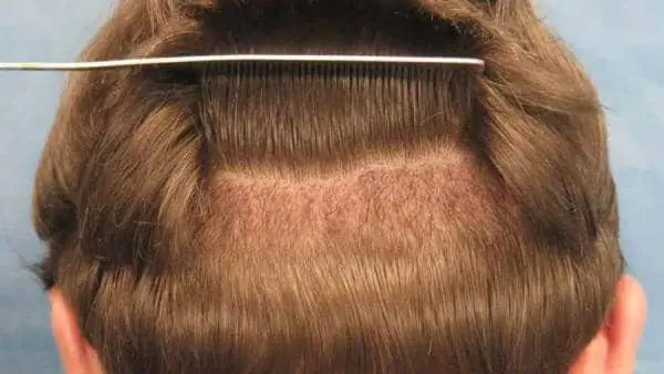 متى تنبت البصيلات بعد زراعة الشعر؟