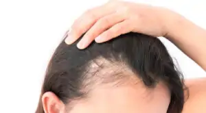 أفضل 5 طرق علاج للصلع الوراثي | زراعة الشعر 2 أفضل 5 طرق علاج للصلع الوراثي