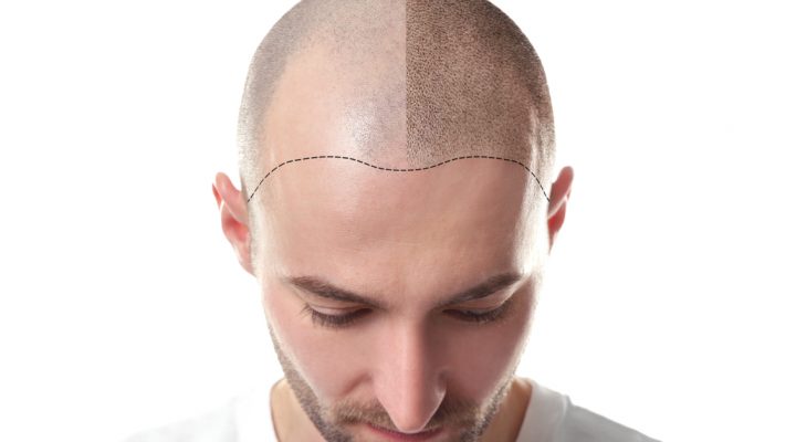 نتائج زراعة الشعر بعد 6 شهور
