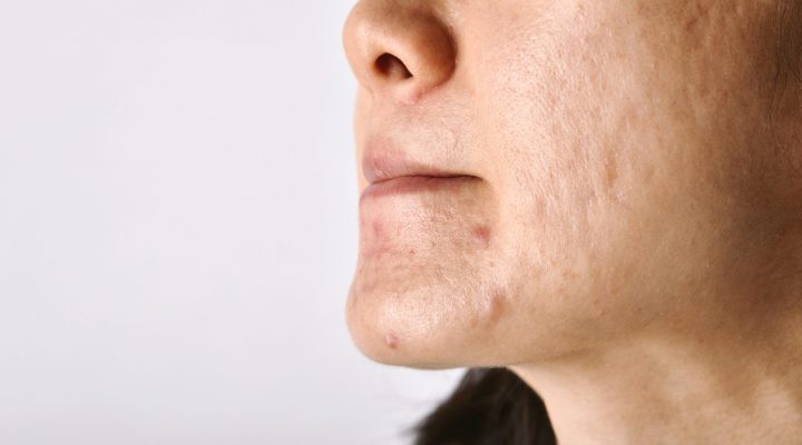 إزالة ندوب الوجه3