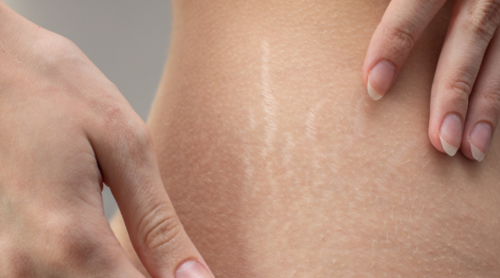 عملية علاج الندوب