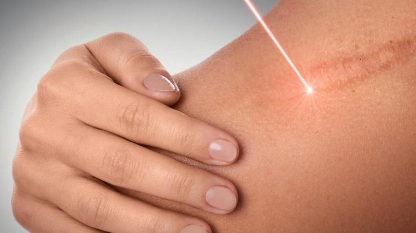 عملية تجميل الحروق والجروح في كارفنج كلينك 1 عملية تجميل الحروق