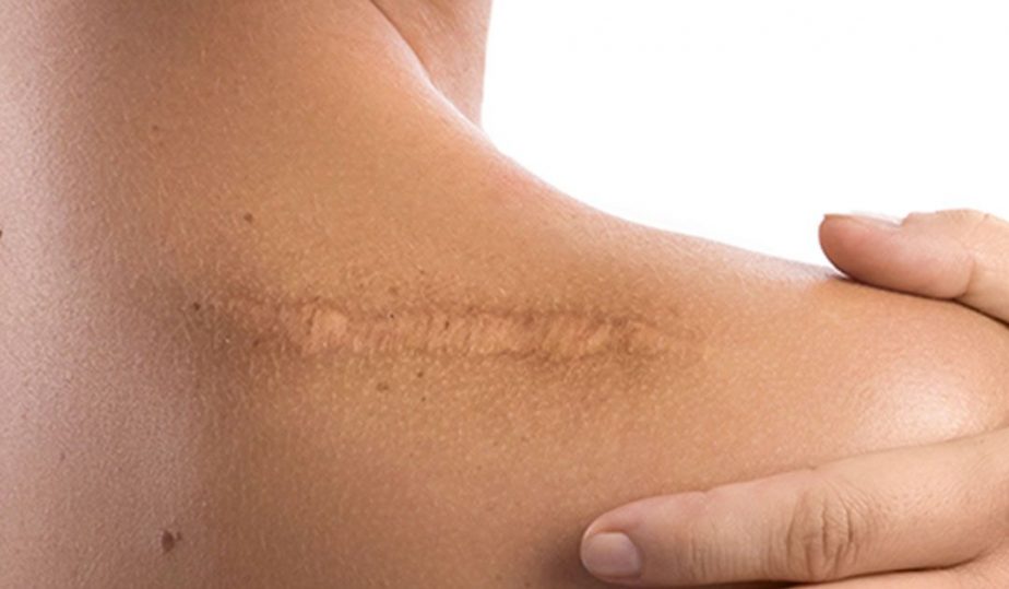 عملية تجميل الحروق والجروح في كارفنج كلينك 4 تجميل الحروق جراحيًا