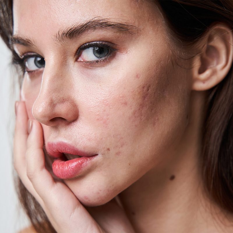 علاج آثار الجروح والخدوش في الوجه | الليزر 3 عمليات تجميل جروح الوجه
