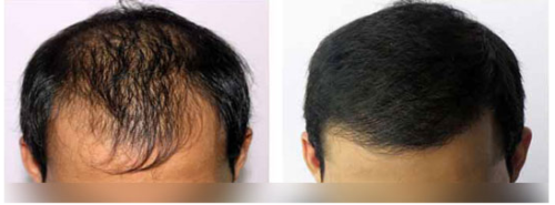 طرق تكثيف الشعر المزروع (البلازما – الليزر)