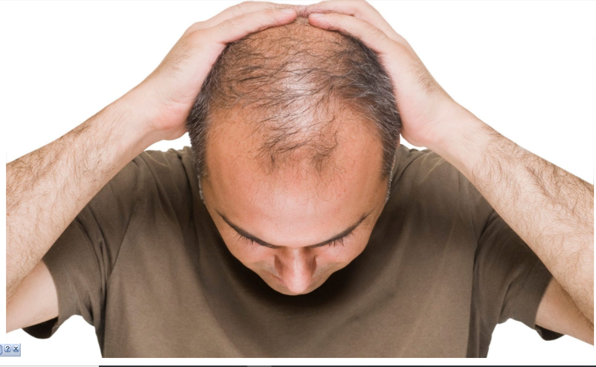 علاج الصلع المبكر ( الأدوية – الوصفات – زراعة الشعر)