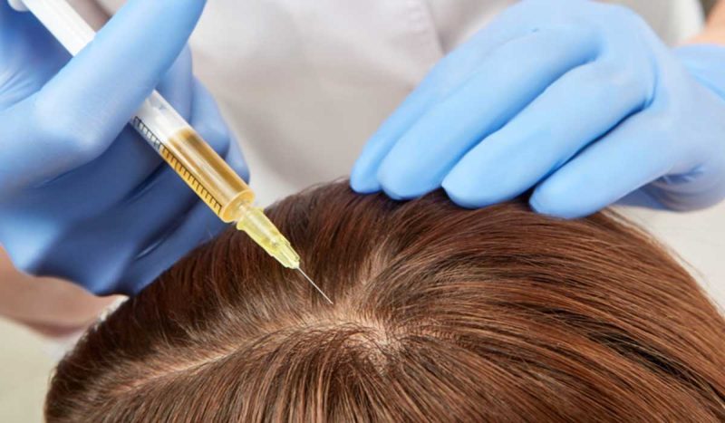 حقن بلازما الشعر