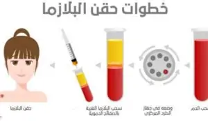 بلازما الشعر (خطوات - إحتياطات - أسعار) 3 خطوات-حقن-البلازما