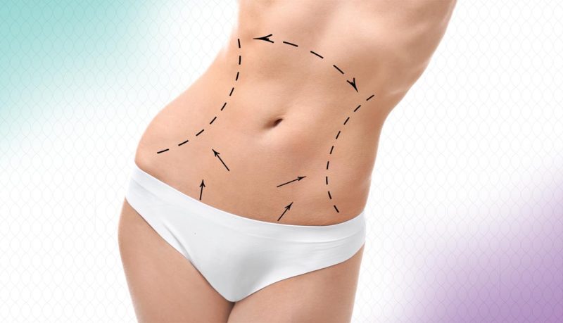 التهاب السرة بعد عملية شد البطن