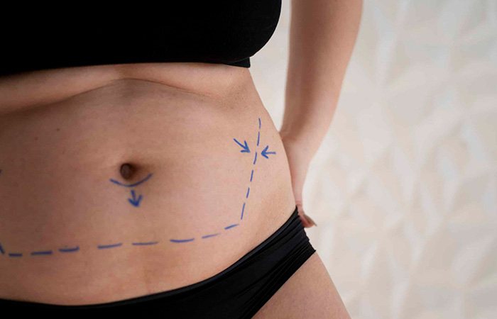 شكل السرة بعد عملية