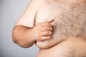 علاج تضخم الثدي عند الرجال 2