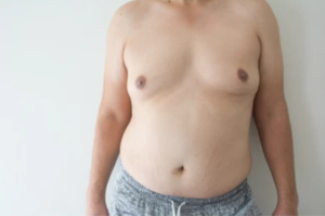 علاج تضخم الثدي عند الرجال 1