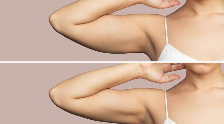 تجربتي مع عملية شد الزنود بالفيزر