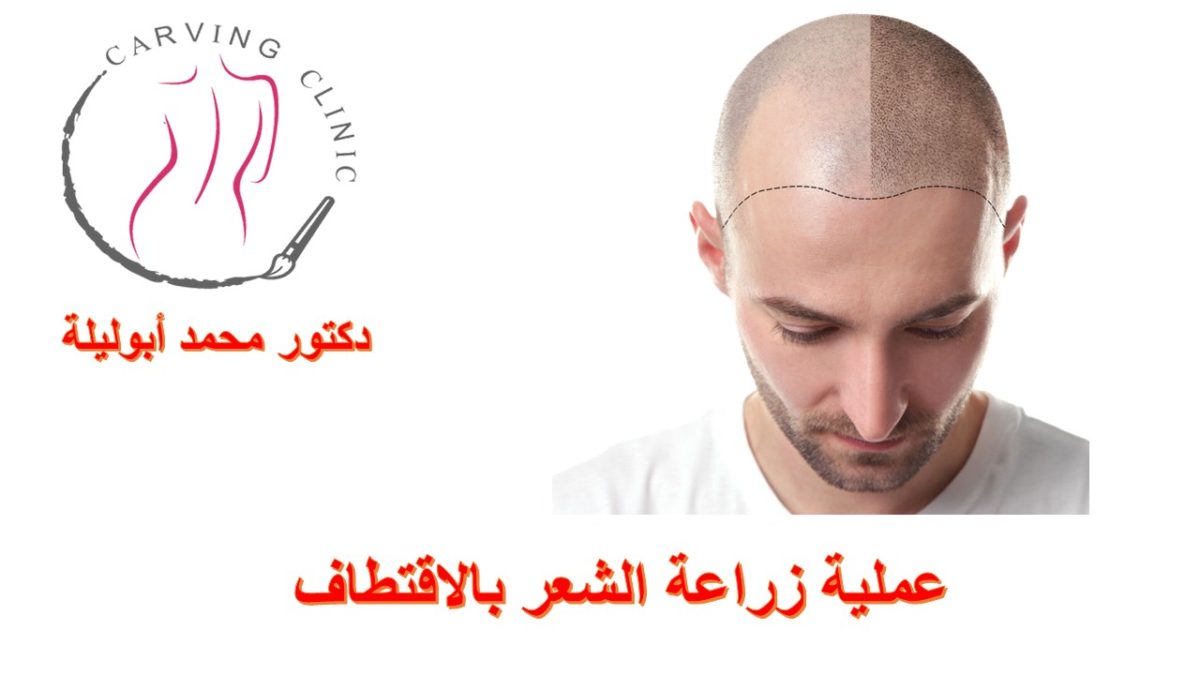 عملية زراعة الشعر بالاقتطاف | العيوب والتعليمات