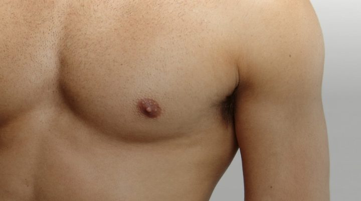 تثدي درجة ثانية