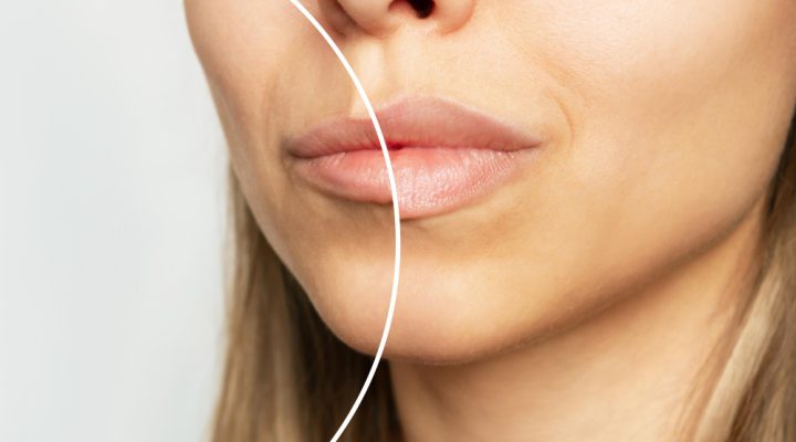 تصغير الشفايف طبيعيا وجراحيا