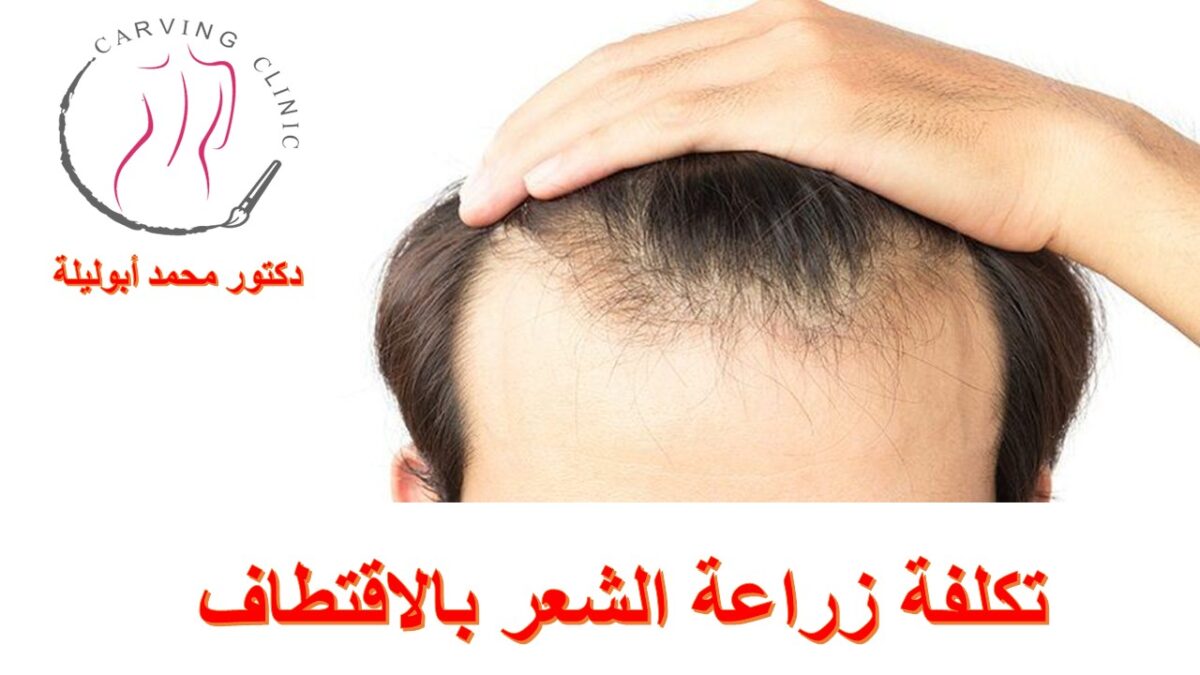 تكلفة زراعة الشعر بالاقتطاف في مصر – 5 مميزات