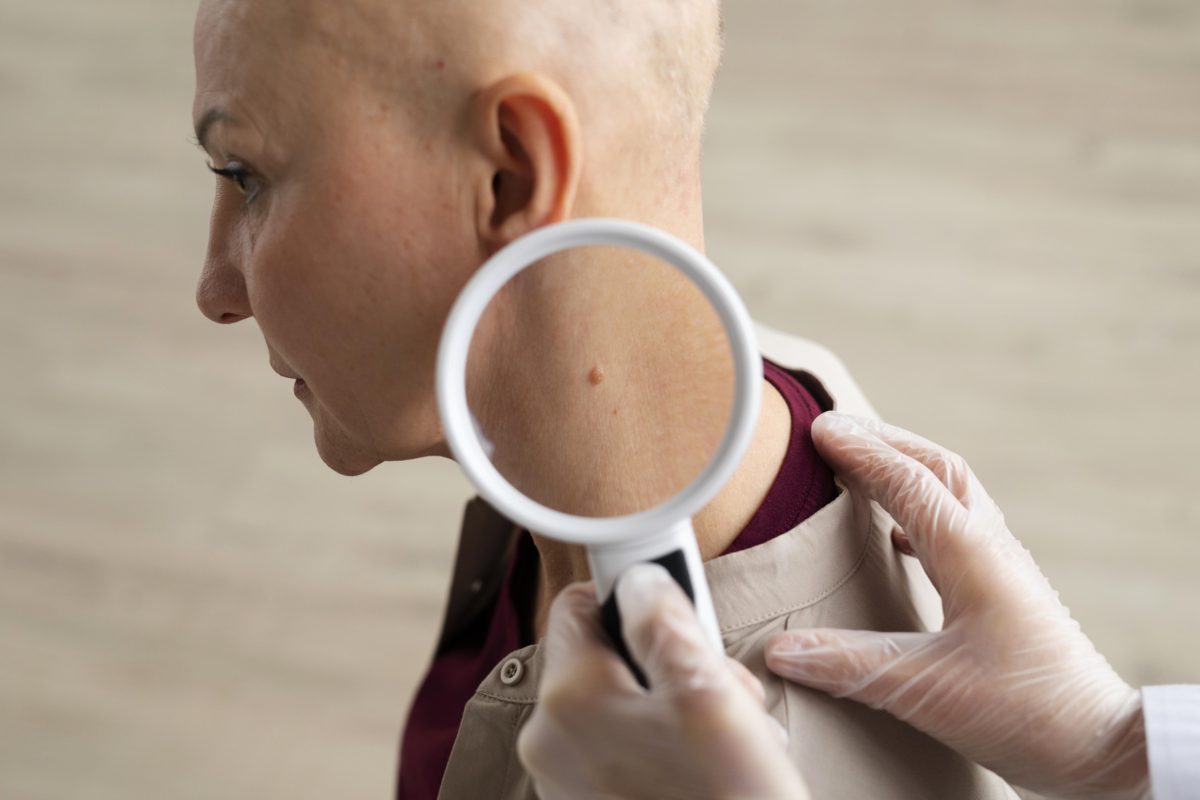 هل سرطان الجلد قاتل؟ (التشخيص – العلاج)