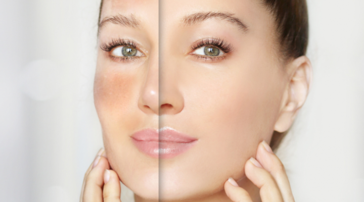 طرق علاج السواد بعد التقشير الكيميائي 