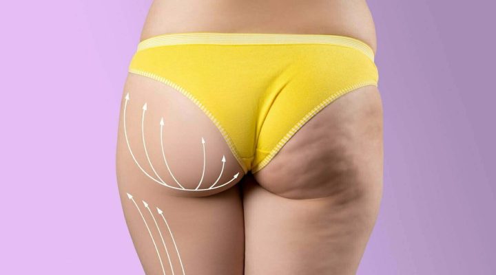 اسباب ترهل المؤخرة وطرق علاجها