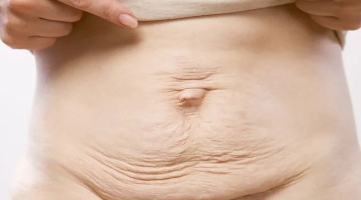 علاج ترهلات البطن