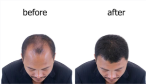 علاج تساقط الشعر الوراثي 2