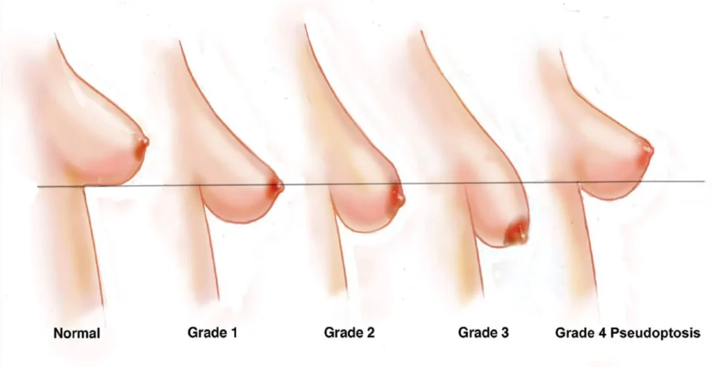 اسباب ترهل الثدي وكيف يتم العلاج في كارفينج كلينك 3 درجات ترهل الثدي بالصور