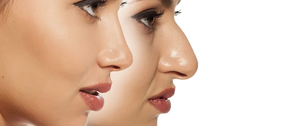 تصغير أرنبة الأنف