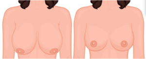 عملية تصغير الثدي 1
