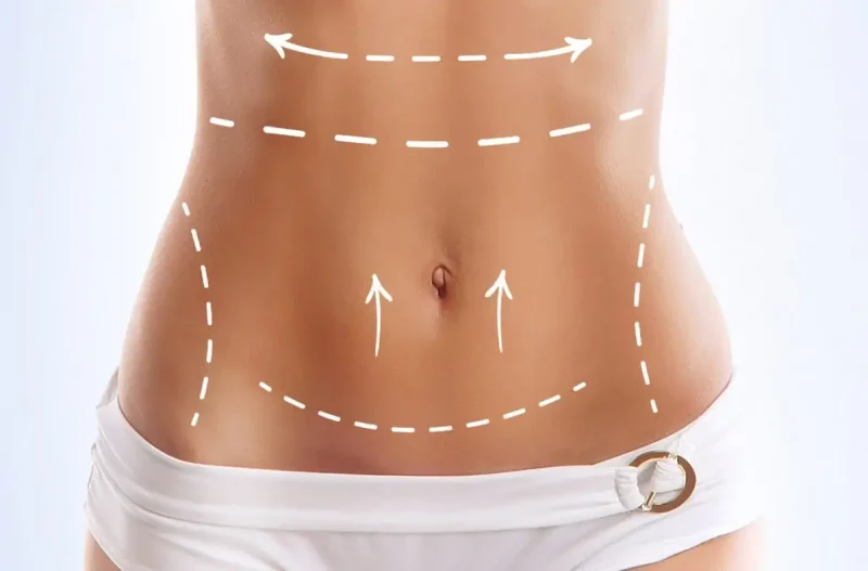 أسعار عمليات شفط الدهون في مصر 2025 2 أنواع عمليات شفط الدهون في مصر