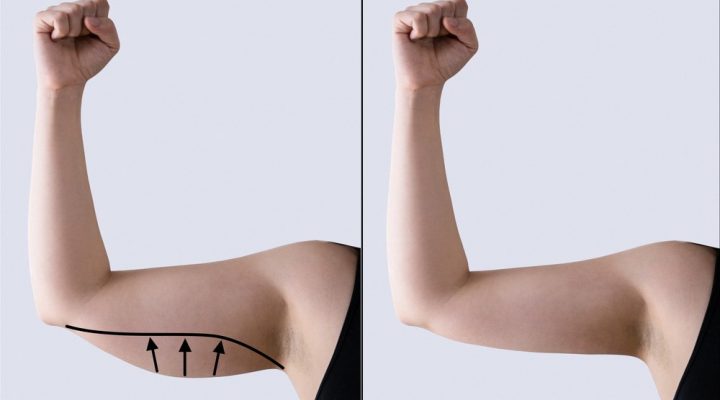 تجربتي مع عملية شد الذراعين