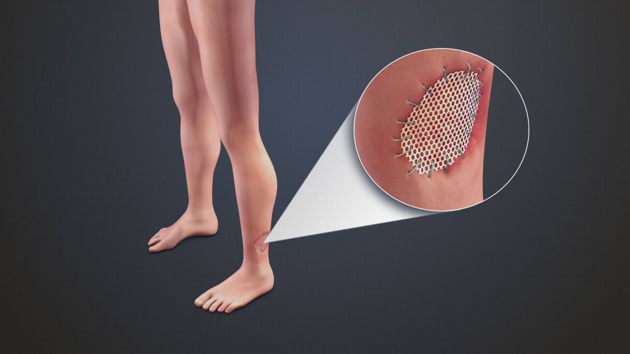 إعادة بناء الجلد المفقود وترقيع الجلد