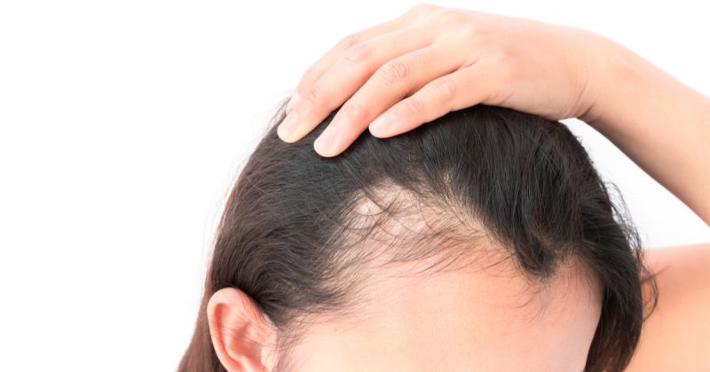 أسرار علاج الصلع الوراثي بشكل نهائي 4 علامات الصلع الوراثي عند النساء