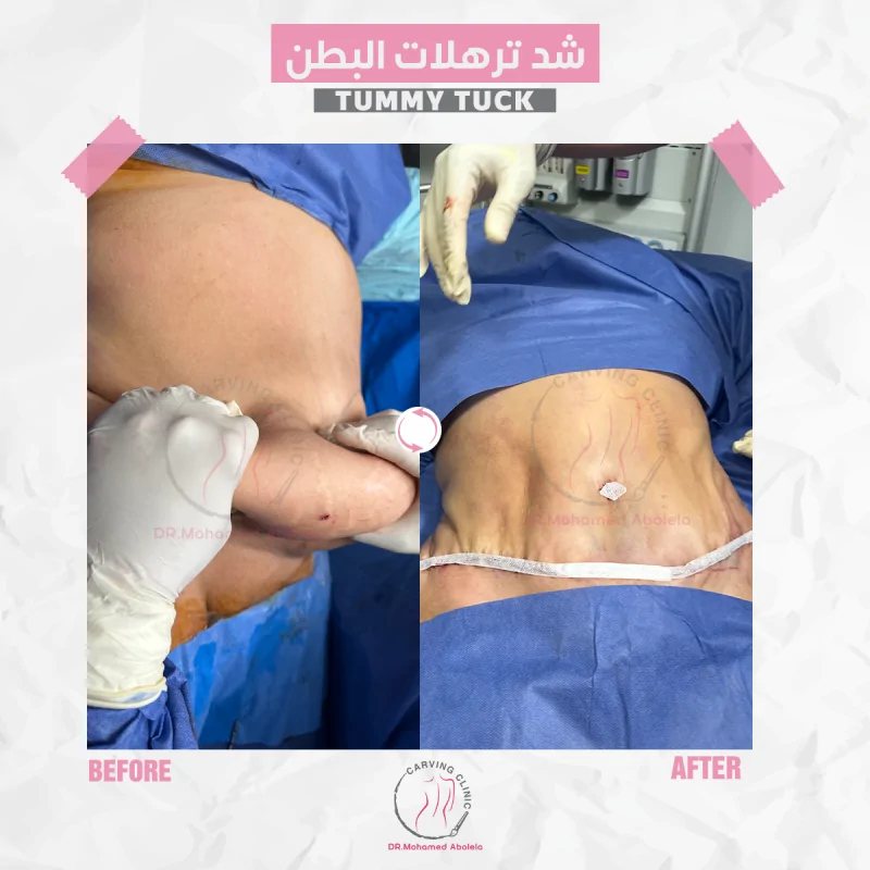 شد ترهلات البطن