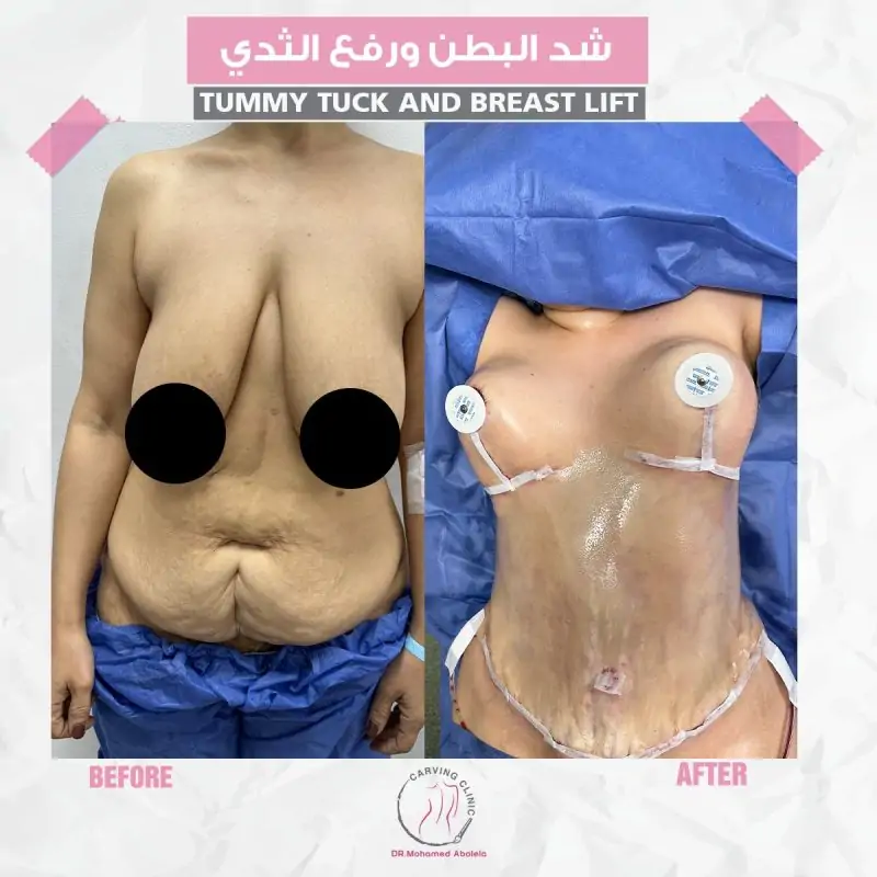 شد البطن ورفع الثدي