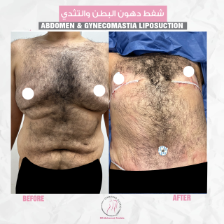 شفط دهون البطن والتثدي